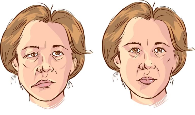 Bells Palsy